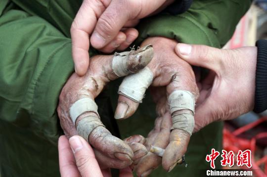 圖為由于常年拾荒，老人雙手布滿傷口。周小云 攝