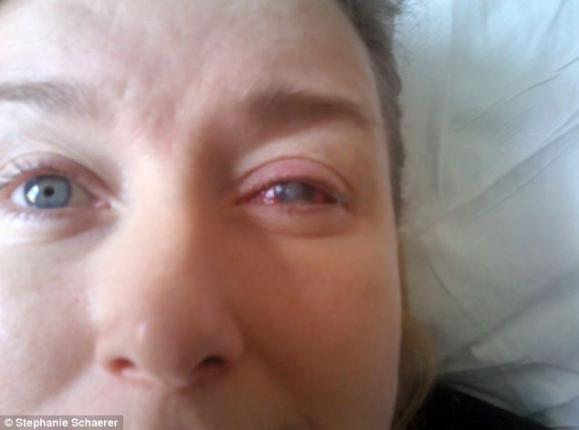 恐怖慎入！隱形眼鏡致英女子摘除眼球
