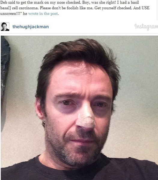 金剛狼休杰克曼得皮膚癌 都是不防曬惹禍 金剛狼休杰克曼得皮膚癌 都是不防曬惹禍