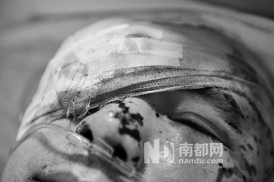 李建新頭部還有被潑硫酸的痕跡，醫(yī)生說被砍傷的右眼已經(jīng)失明。 南都記者 田飛 攝
