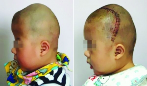 術前（左），術后（右）