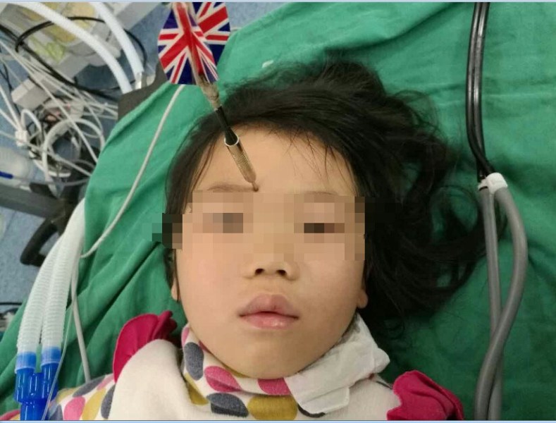 十多公分長的飛鏢穩(wěn)穩(wěn)地 ” 定 ” 在了一名六歲半的女童額頭上，小青一家人凌晨從長順趕到貴醫(yī)附院急診室時(shí)，看到如此慘烈的情況，接診醫(yī)生都嚇了一跳。詳細(xì)詢問下得知，原來是七歲的哥哥和六歲半的表妹在玩耍時(shí)，哥哥不慎將路邊撿來的真飛鏢扎到了妹妹的額頭上。