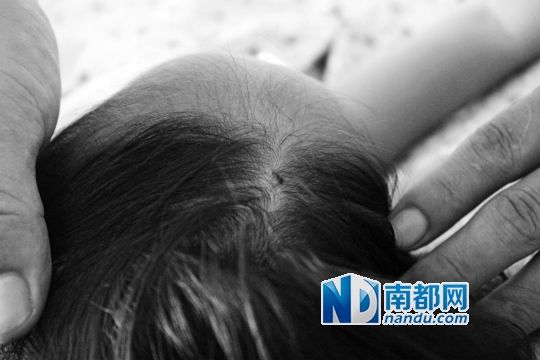 女童頭上被扎的針孔（圓圈處）。賈先生說，被扎不到三秒鐘，女兒就昏了。