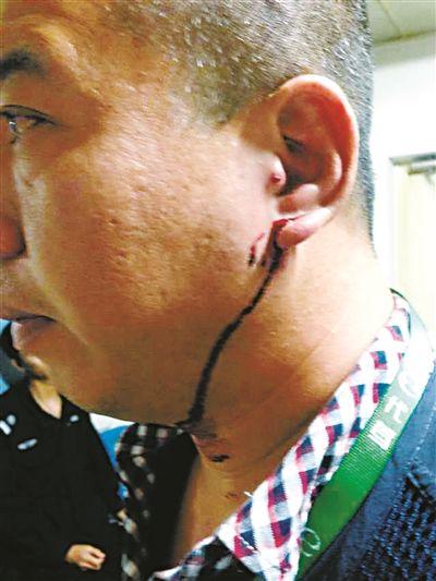 李師傅耳朵受傷,縫了4針 李師傅耳朵受傷,縫了4針