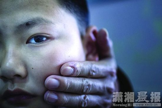 1月13日，小玨的父親心疼地摸著兒子的臉。