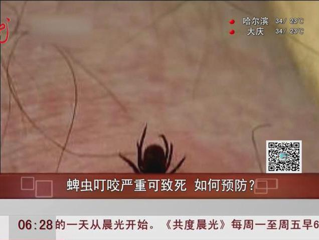 蜱蟲叮咬嚴重可致死如何預防？
